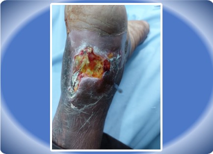 DIABETIC FOOT